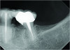 Fig 11. If extracoronal splinting was performed, an especially aggressive resection is needed to ensure that adequate cleaning is possible.