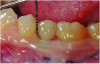 Fig 1. The patient presented with a probing depth of 6 mm to 8 mm at site No. 20 and bleeding on probing.