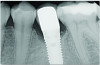 Fig 2. A radiograph of the dental implant area before treatment depicted the defect angle, which was less than 40%.