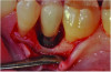 Fig 4. Intraoperative surgical assessment of the peri-implant defect showed the area after cleaning.