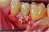 Fig 6. The graft material was placed and packed into the defect and supracrestally.