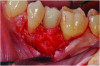 Fig 7. A collagen membrane hydrated with rhPDGF-BB was placed over the defects with interproximal extensions.