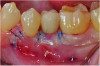 Fig 8. Flaps were sutured using nonresorbable 6-0 polypropylene after coronal positioning.