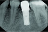 Fig 9. Immediate postoperative radiograph.