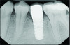 Fig 11. Radiograph at 9-month follow-up showing intrabony defect fill.