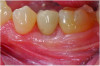 Fig 12. Clinical presentation at 9-month follow-up showing complete regeneration and interproximal papillae.