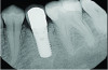 Fig 13. Radiograph at 6-year recall.