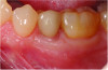 Fig 14. Clinical presentation at 6-year recall showing stable results.