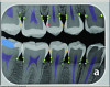 Fig 4. Artificial intelligence (AI) caries detection demonstrating several incipient enamel lesions.