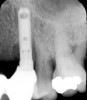 Figure 4 Radiograph of site No. 12 manifesting alveolar bone loss that is associated with an infection. (Radiograph courtesy of Dr. John Cavallaro.)