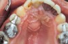 Figure 5 Palatal abscess due to non-vitality of tooth No. 8.