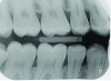 Fig 1. On a conventional dental radiograph, areas of concern, in this case proximal decay, can be difficult for the patient to see on the black and
white image.