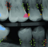 Fig 3. Dental AI software may be utilized to detect bone loss.