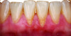 Fig 1. Frontal (Fig 1) and profile (Fig 2) views of mandibular incisors with a thin scalloped periodontal phenotype. Note the lack of keratinized tissue, thin gingiva, gingival recession defects (RT1–A-), and plaque present.