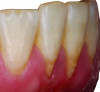 Fig 2. Frontal (Fig 1) and profile (Fig 2) views of mandibular incisors with a thin scalloped periodontal phenotype. Note the lack of keratinized tissue, thin gingiva, gingival recession defects (RT1–A-), and plaque present.