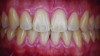Fig 3. Frontal view of a thick scalloped periodontal phenotype. Similar to the case with a thin scalloped phenotype shown in Fig 1, a narrow band of keratinized tissue, slender crown forms, and narrow interdental contacts are present. Tooth No. 25 underwent a root coverage and phenotype modification with a CTG and tunnel subsequent to orthodontically induced gingival recession.