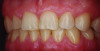 Fig 4. Example of a thick flat periodontal phenotype. Note the long interproximal contacts, rectangular crown form, and wide band of keratinized tissue, characteristics that are in contrast to scalloped phenotypes.