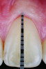 Fig 5. Example of a thick gingival phenotype, as assessed by the lack of midfacial transmucosal probe visibility (ie, when inserted into the gingival sulcus, the probe is not visible through the gingiva).