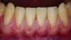 Fig 6. Preoperative view of a patient referred for correction of mucogingival deformities prior to orthodontic therapy. Among the conditions identified were a thin scalloped periodontal phenotype, limited keratinized tissue (less than 2 mm in some areas), and gingival recession (RT1–A- at all sites).