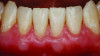 Fig 7. Postoperative view of the patient shown in Fig 6 after 4 months of healing subsequent to PhMT-s via CTG with modified VISTA technique across the entire mandibular arch. Note the augmented, thick gingiva, abundance of keratinized and attached tissue (with increased vestibular depth), and 100% root coverage.