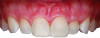 Fig 8. A patient with thick flat phenotype. Note the patient’s natural presentation with thick gingiva, a broad zone of keratinized tissue, and rectangular crowns with long interdental contacts.