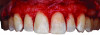 Fig 9. Thick alveolar bone and exostoses were revealed in the patient shown in Fig 8 by reflection of a facial mucoperiosteal flap for crown lengthening.