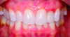 Fig 11. Frontal view of an orthodontic patient with a thin scalloped periodontal phenotype, demonstrating minimal keratinized tissue width around the mandibular incisors, prominent roots, and root exposure of the mandibular posterior teeth.