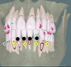 Fig 13. The treatment simulation showing root dehiscences and fenestrations (dark red outlines) after tooth movement. By knowing this outcome before it occurs, clinicians can plan for phenotype modification prior to orthodontic treatment to prevent root exposure.