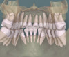 Fig 14. Planning software treatment simulation based on CBCT and intraoral scanning for a patient planned for orthodontic therapy using clear aligners. Fig 14: Initially, prior to any tooth movement, the teeth were malpositioned, but the roots were largely within the alveolar housing. Fig 15: The treatment simulation at the final stage showed root dehiscences (red outlines) at the maxillary and mandibular incisors on the lingual aspect. This case was planned for SFOT with PhMT-b to both thicken the periodontal phenotype and accelerate tooth movement. Without this additional intervention, the roots would likely be denuded with deep recession on the lingual aspect.