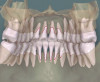Fig 15. Planning software treatment simulation based on CBCT and intraoral scanning for a patient planned for orthodontic therapy using clear aligners. Fig 14: Initially, prior to any tooth movement, the teeth were malpositioned, but the roots were largely within the alveolar housing. Fig 15: The treatment simulation at the final stage showed root dehiscences (red outlines) at the maxillary and mandibular incisors on the lingual aspect. This case was planned for SFOT with PhMT-b to both thicken the periodontal phenotype and accelerate tooth movement. Without this additional intervention, the roots would likely be denuded with deep recession on the lingual aspect.