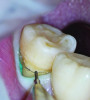 Fig 2. After retraction cord was packed all around the tooth under the microscope, the previous margin marks were refreshed for accurate orientation of the preparation.