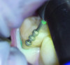 Fig 3. Preparation of the tooth began with the use of a depth indicator bur, first on the vestibular, then on the distal and coronal aspects.