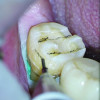 Fig 4. The desired preparation depth of 1 mm was marked.