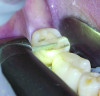 Fig 5. The occlusal grooves were linked around the entire tooth structure using a diamond bur.