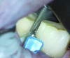 Fig 6. After the rounded shoulder margins were defined, the approximal contact was broken, with a wedge-matrix combination protecting the adjacent tooth. This was done under full microscopic control.