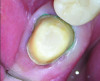 Fig 7. Occlusal view after finishing the minimally invasive preparation.