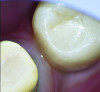 Fig 8. Microscopic view of the approximal zone, showing no harm to the adjacent implant crown and sufficient spacing.