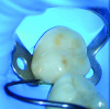 Fig 16. Initial intraoral fit check, from all aspects, was done under the microscope, directly and indirectly.