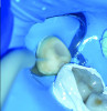 Fig 18. The tooth abutment was rinsed and dried.