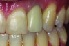 Fig 2. Titanium abutment is visible through the soft tissue of an anterior implant restoration on the maxillary left lateral incisor.