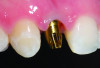 Fig 3. Gold anodized titanium custom abutment in preparation for crown cementation.