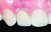 Fig 4. Lithium-disilicate crown cemented over the gold anodized titanium custom abutment shown in Fig 3.