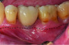 Fig 1. The peri-implant mucosa of implant No. 19 presents erythema with a lack of KMW. The dark color of the underlying restoration is showing through the thin peri-implant mucosa. The dotted line indicates the MGJ. The distance from the margin of the peri-implant mucosa to the MGJ is the KMW.