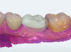 Fig 2. A digital scan of a mandibular arch, including a missing tooth No. 19 with a digital tooth setup. The dotted line indicates the MGJ.