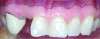 Fig 3. Clinical condition at the diagnosis of a missing tooth No. 7. The dotted line indicates the MGJ.