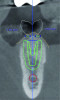 Fig 4. Digital tooth setup; the digital scan in Fig 2 was superimposed with a CBCT. The blue dots with green horizontal lines indicate MT measurements (2.04 mm and 2.02 mm). The simulated implant (green diagram of a dental implant with threads) and safety zone (green outline around the diagram of the implant) are overlaid on a cross-sectional image of the alveolar ridge. The red circle indicates the inferior alveolar nerve canal.