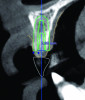 Fig 5. Digital tooth setup for missing tooth No. 7 in Fig 3, superimposed with a CBCT. The blue dots with green horizontal line indicate MT measurement (1.03 mm). The simulated implant (green diagram of a dental implant with threads) and safety zone (green outline around the diagram of the implant) are overlaid on a cross-sectional image of the alveolar ridge.