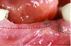 Fig 6 through Fig 8. Example of increasing KMW with an APF at implant uncovery. Fig 6: initial presentation showing lack of KMW; Fig 7: healing abutment placement with APF; Fig 8: 2 months post-treatment. (The dotted lines indicate the MGJ.) Fig 9 through Fig 11. Example of increasing KMW with an APF and FGG at implant uncovery.
