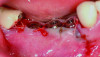 Fig 6 through Fig 8. Example of increasing KMW with an APF at implant uncovery. Fig 6: initial presentation showing lack of KMW; Fig 7: healing abutment placement with APF; Fig 8: 2 months post-treatment. (The dotted lines indicate the MGJ.) Fig 9 through Fig 11. Example of increasing KMW with an APF and FGG at implant uncovery.