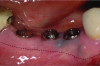Fig 6 through Fig 8. Example of increasing KMW with an APF at implant uncovery. Fig 6: initial presentation showing lack of KMW; Fig 7: healing abutment placement with APF; Fig 8: 2 months post-treatment. (The dotted lines indicate the MGJ.) Fig 9 through Fig 11. Example of increasing KMW with an APF and FGG at implant uncovery.